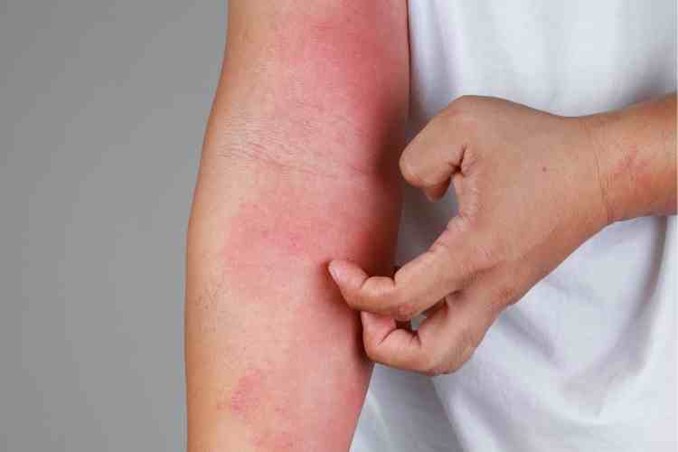  Congedi e agevolazioni causa alleregie